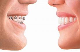 Image result for Ideal Bite Teeth