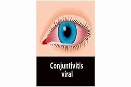 Image result for Conjuntivitis