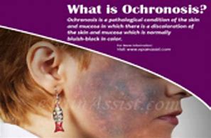 Image result for Ochronosis Knee