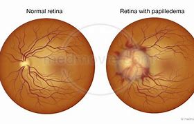 Image result for papilledema causes