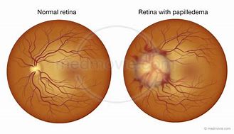 Image result for Papilledema