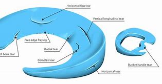 Image result for Meniscal Tear Treatments