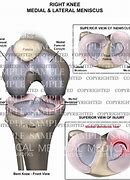 Image result for Right Knee Meniscus