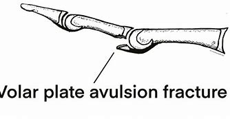 Image result for Volar Fracture