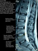 Image result for Lumbar Spine MRI Meme