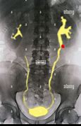 Image result for Kidney On X-ray