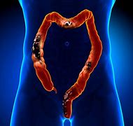 Image result for Human Body Colon Cancer