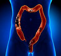 Image result for Pics of Colon Cancer