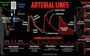 Image result for Arterial Emboli