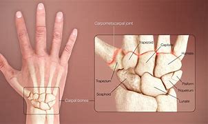 Image result for Wrist Injury