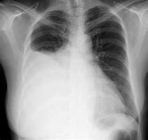 Image result for Pleural Effusion Images