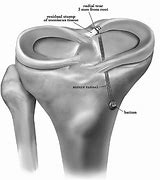 Image result for Right Knee Meniscus