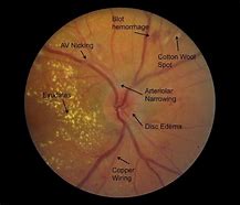 Image result for High Blood Pressure Eye Symptoms