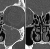 Image result for Infundibulum Nose