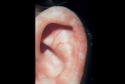 Image result for Louis Bar Syndrome