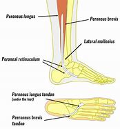 Image result for Peroneal Tendinopathy