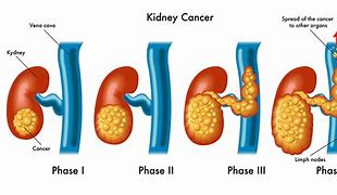 Image result for Kidney Cancer Tumor