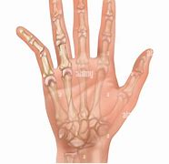 Image result for What Does a Dislocated Pinky Look Like