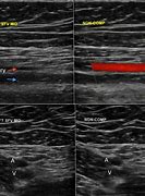 Image result for SCV Thrombosis