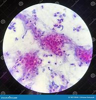 Image result for Mycobacterium GM's Stain