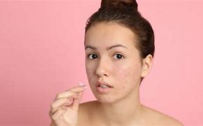 Image result for Itchy Face with Pimples