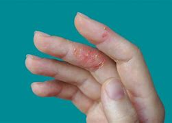 Image result for Eczema On Hands