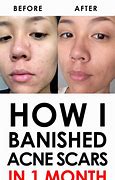 Image result for Banish Acne Scars