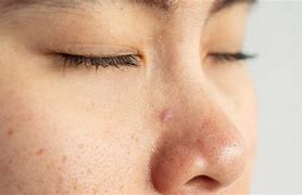 Image result for Blackhead Pores Clean