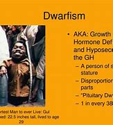 Image result for Gigantism Acromegaly and Dwarfism