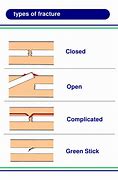 Image result for Open Fracture First Aid