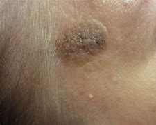 Image result for Flat Skin Warts