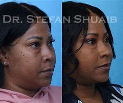 Image result for African American Rhinoplasty