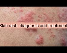 Image result for Diagnose Skin Rash