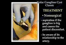 Image result for Volar Wrist Cyst