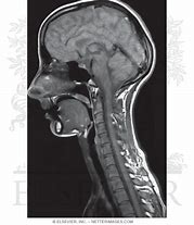 Image result for T1 MRI Head