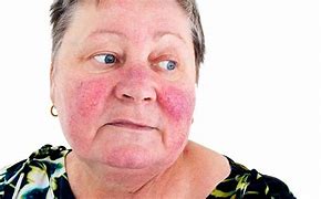 Image result for Irritated Skin On Face