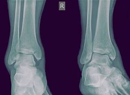 Image result for Lateral Malleolus Fracture Splint