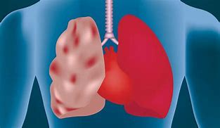 Image result for Chronic Emphysema