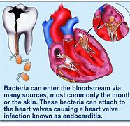 Image result for Acute Endocarditis