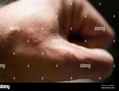 Image result for Allergic Reaction with Pustules