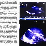 Image result for Septal Aneurysm