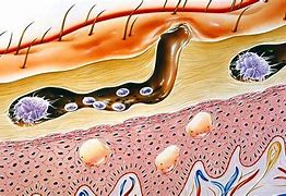 Image result for Mites Under Skin