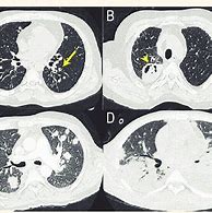 Image result for CT Chest Lung Window