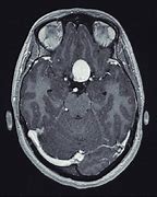 Image result for Aneurysm in MRI