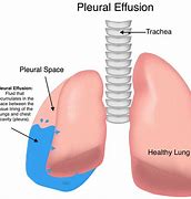 Image result for Pleural Infection