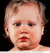 Image result for Mumps Child