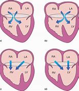 Image result for Unbalanced AV Canal