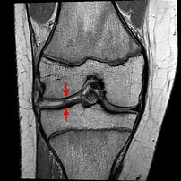 Image result for Knee Joint Meniscus