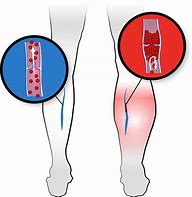 Image result for Thrombose Veineuse Musculaire IRM