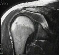 Image result for Shoulder MRI